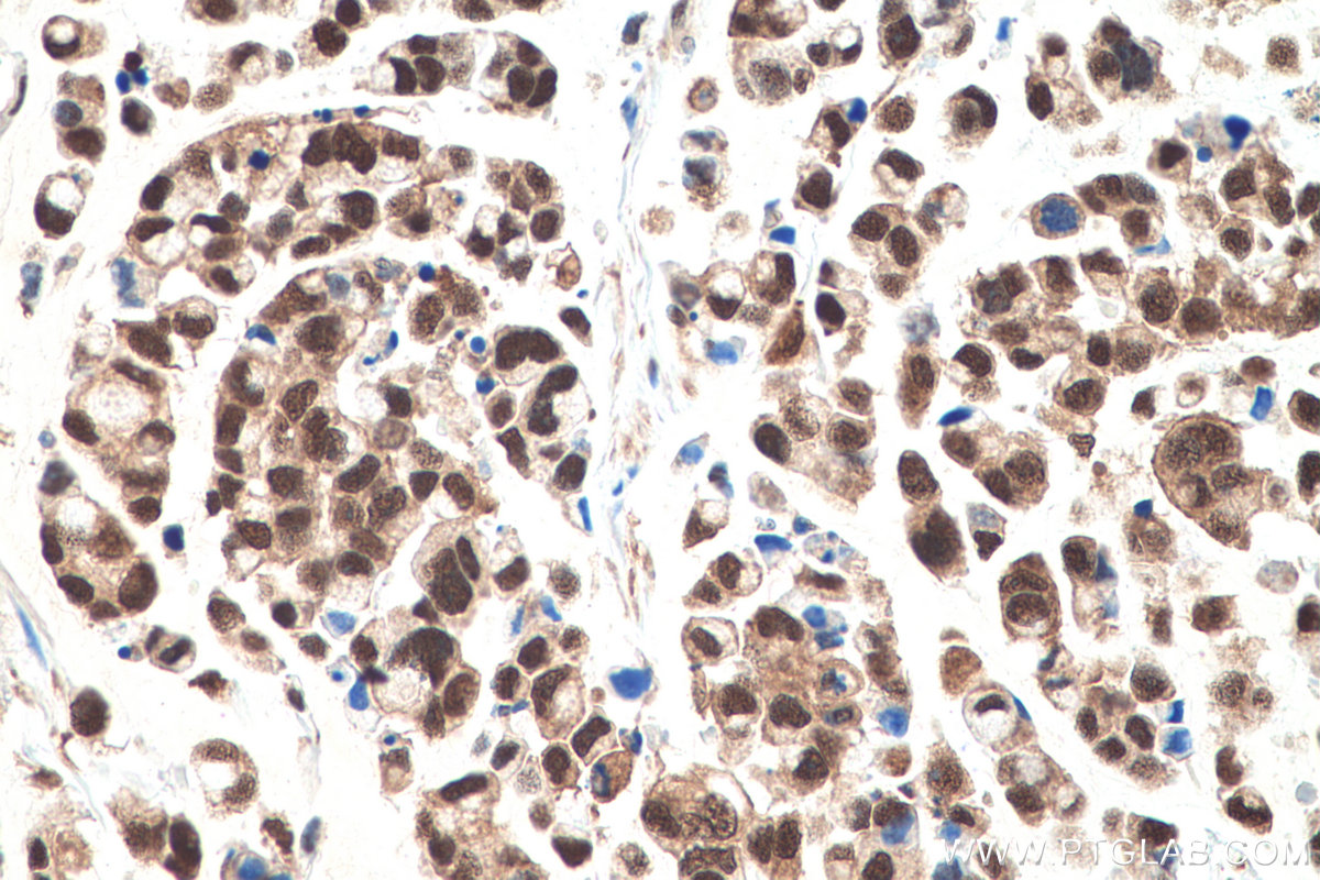 IHC staining of human colon cancer using 60316-1-Ig