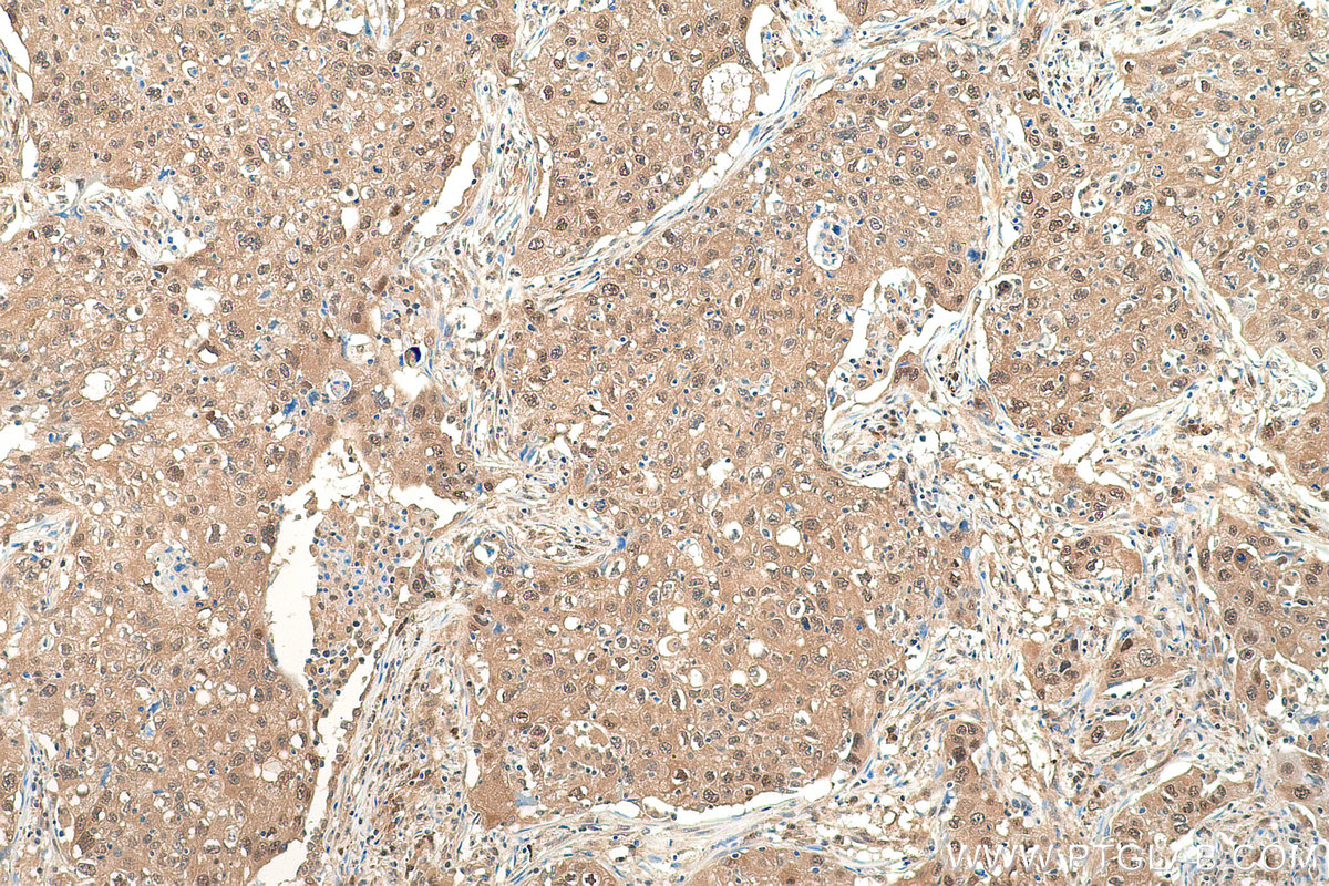 IHC staining of human lung cancer using 60316-1-Ig