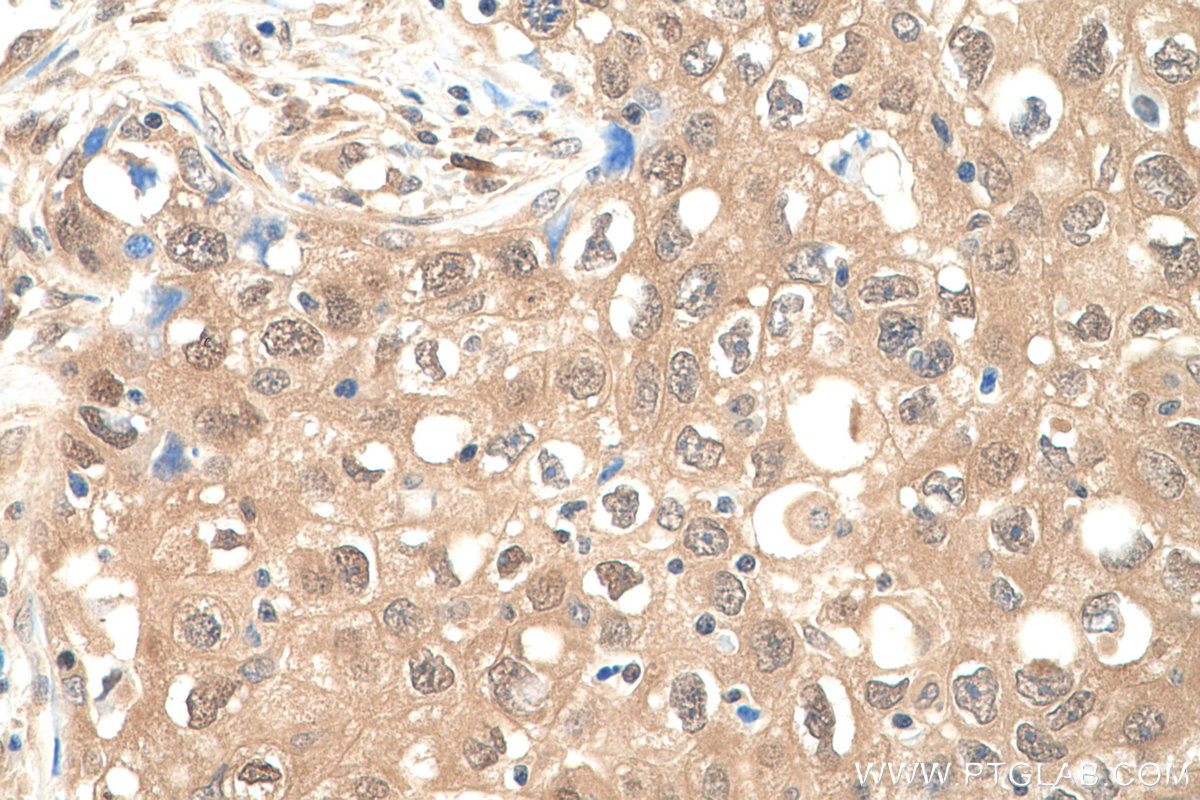 IHC staining of human lung cancer using 60316-1-Ig