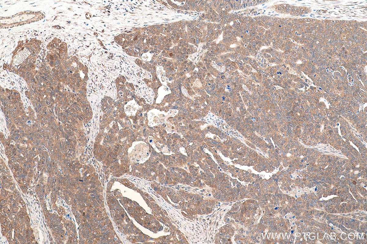 IHC staining of human ovary tumor using 60316-1-Ig