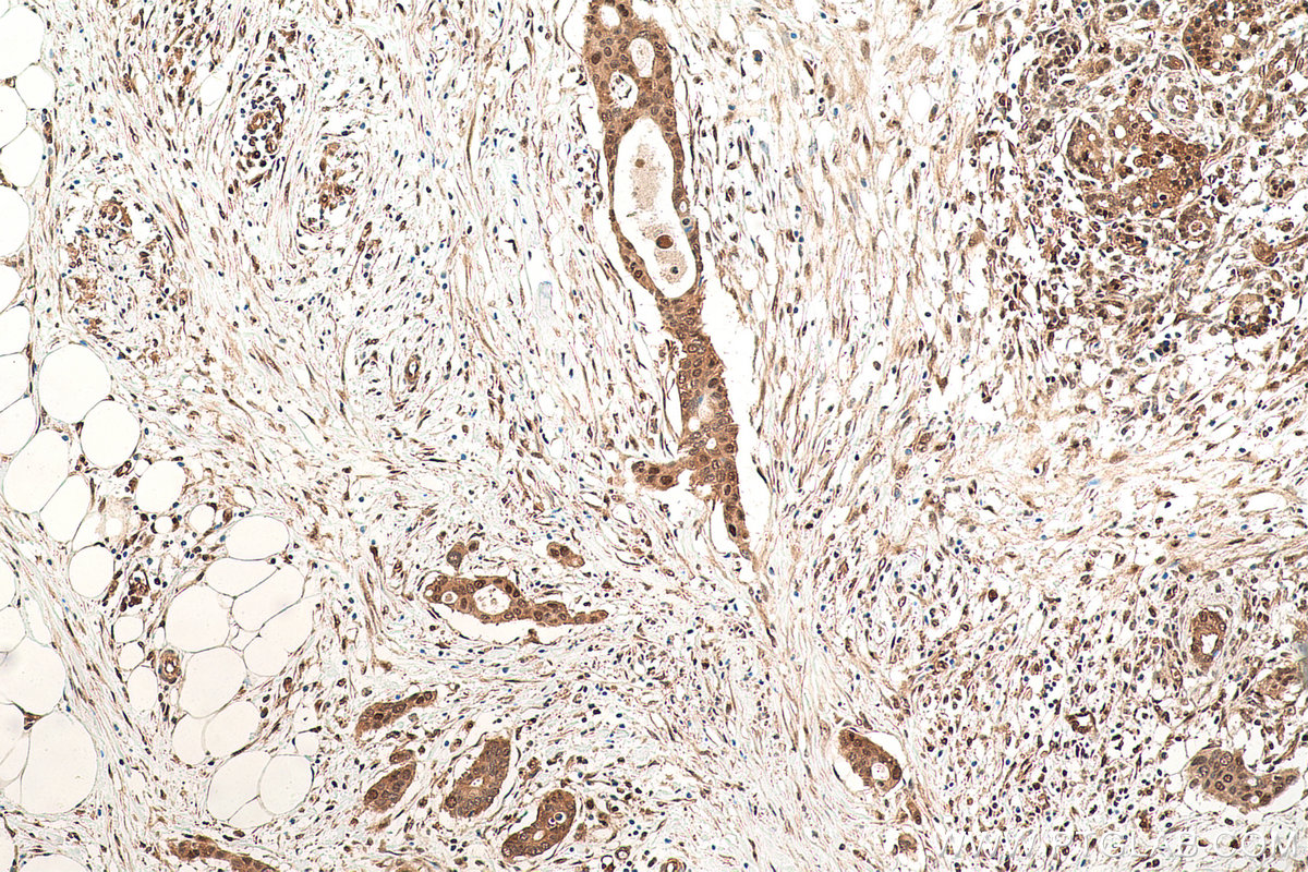 IHC staining of human pancreas cancer using 60316-1-Ig