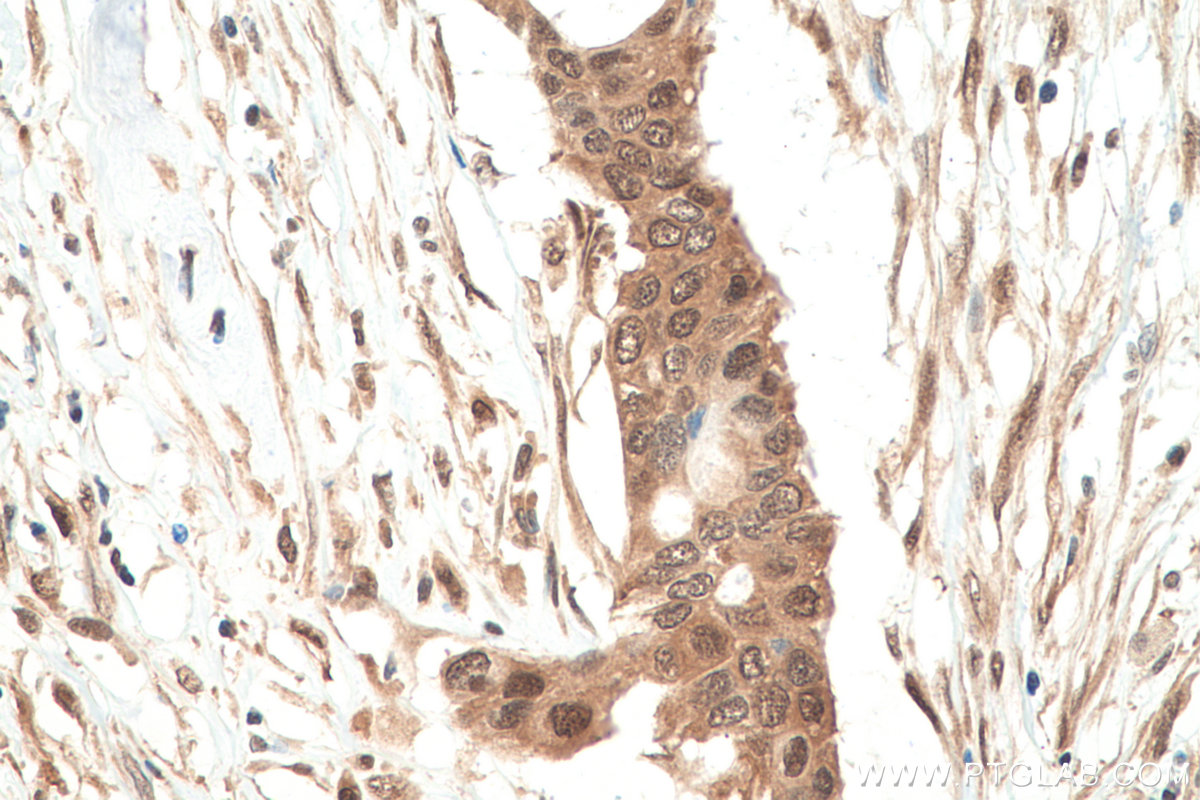 IHC staining of human pancreas cancer using 60316-1-Ig