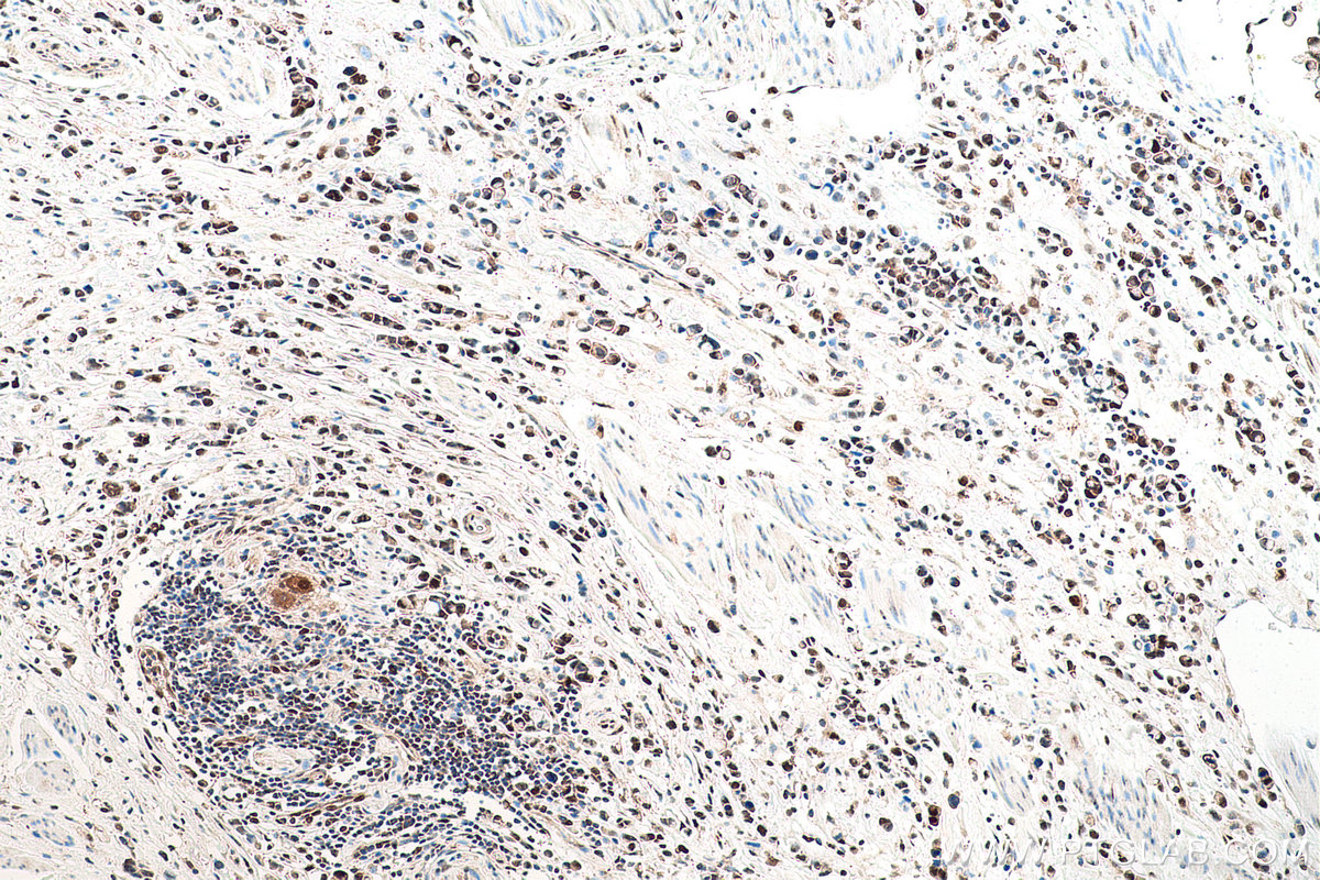 IHC staining of human stomach cancer using 60316-1-Ig