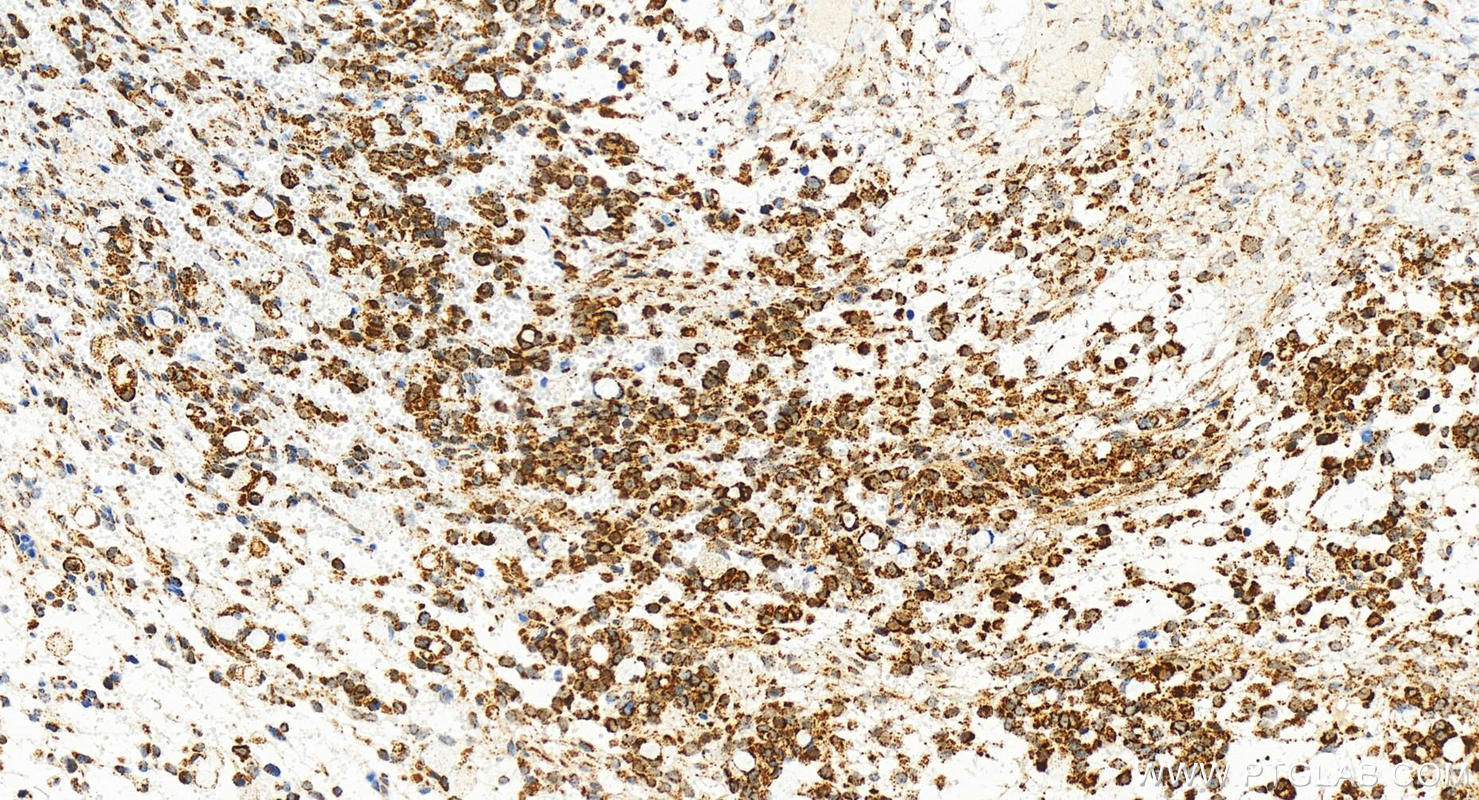 IHC staining of human ovary cancer using 82666-14-RR (same clone as 82666-14-PBS)