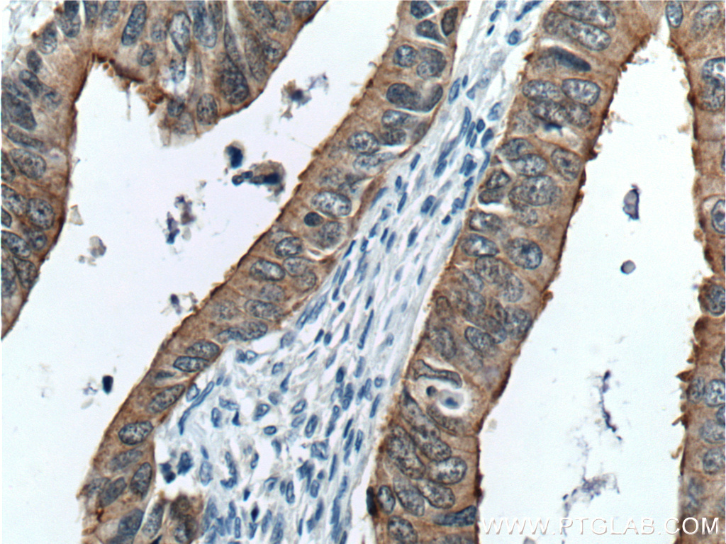 IHC staining of human colon cancer using 66096-1-Ig (same clone as 66096-1-PBS)