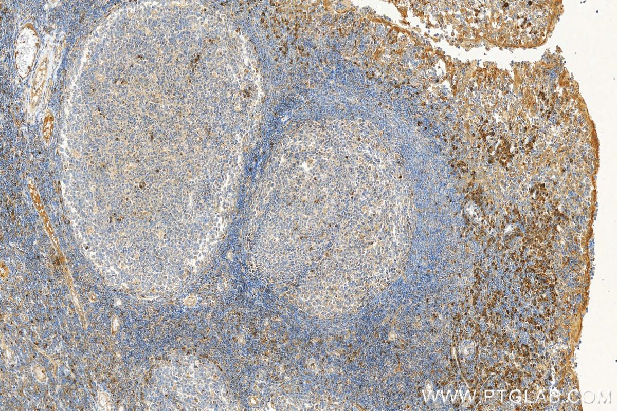 IHC staining of human tonsillitis using 31619-1-AP