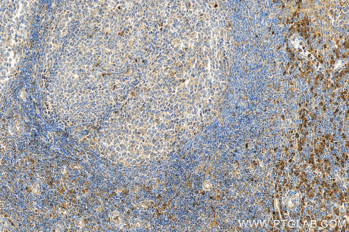 IHC staining of human tonsillitis using 31619-1-AP