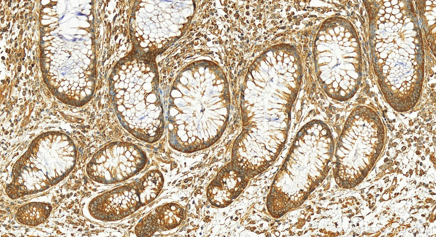 IHC staining of human colon cancer using 12195-1-AP (same clone as 12195-1-PBS)