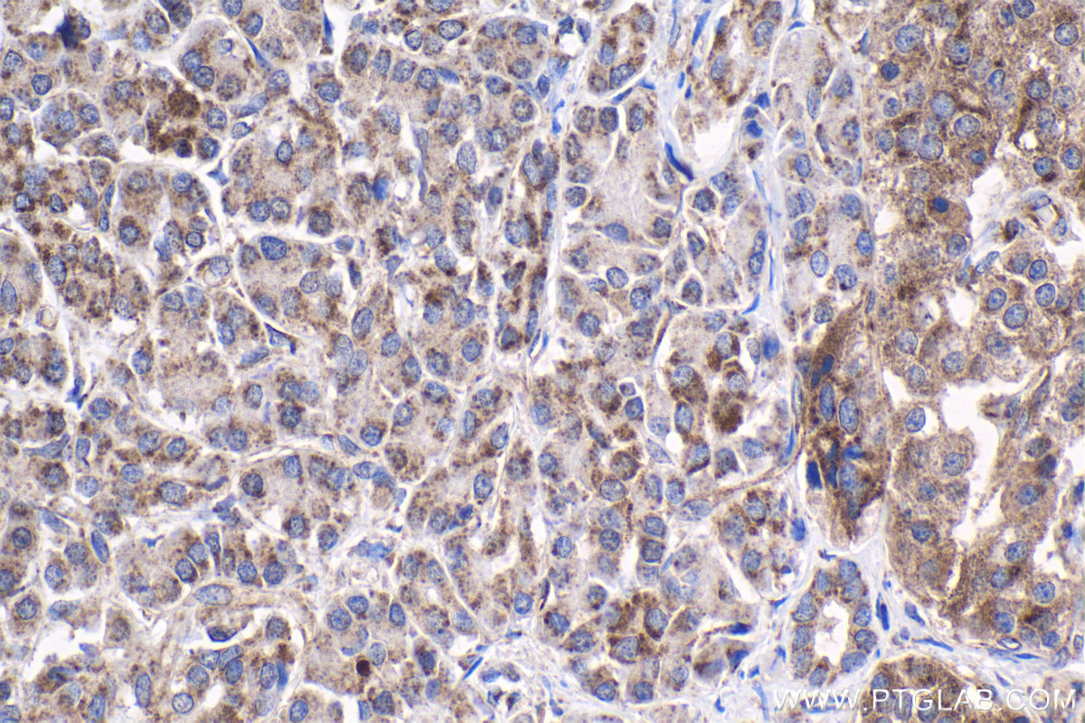 IHC staining of human pancreas cancer using 14262-1-AP