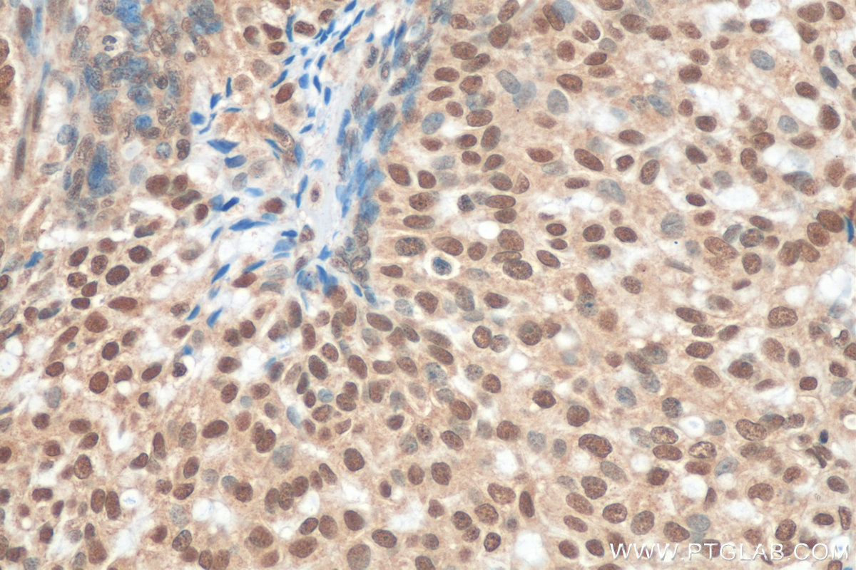 IHC staining of human breast hyperplasia using 15143-1-AP