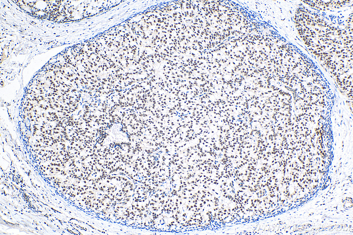 IHC staining of human breast hyperplasia using 15143-1-AP