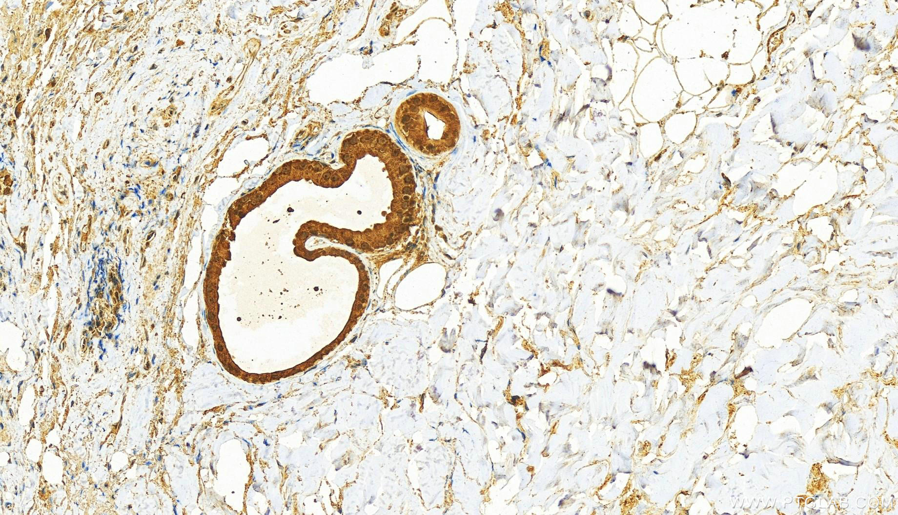 IHC staining of human skin cancer using 28018-1-AP