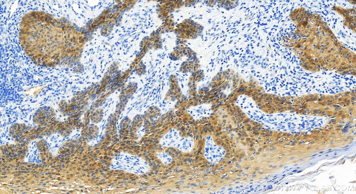 IHC staining of Human bowens disease using 13919-1-AP