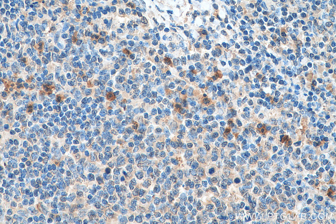 IHC staining of human tonsillitis using 24382-1-AP