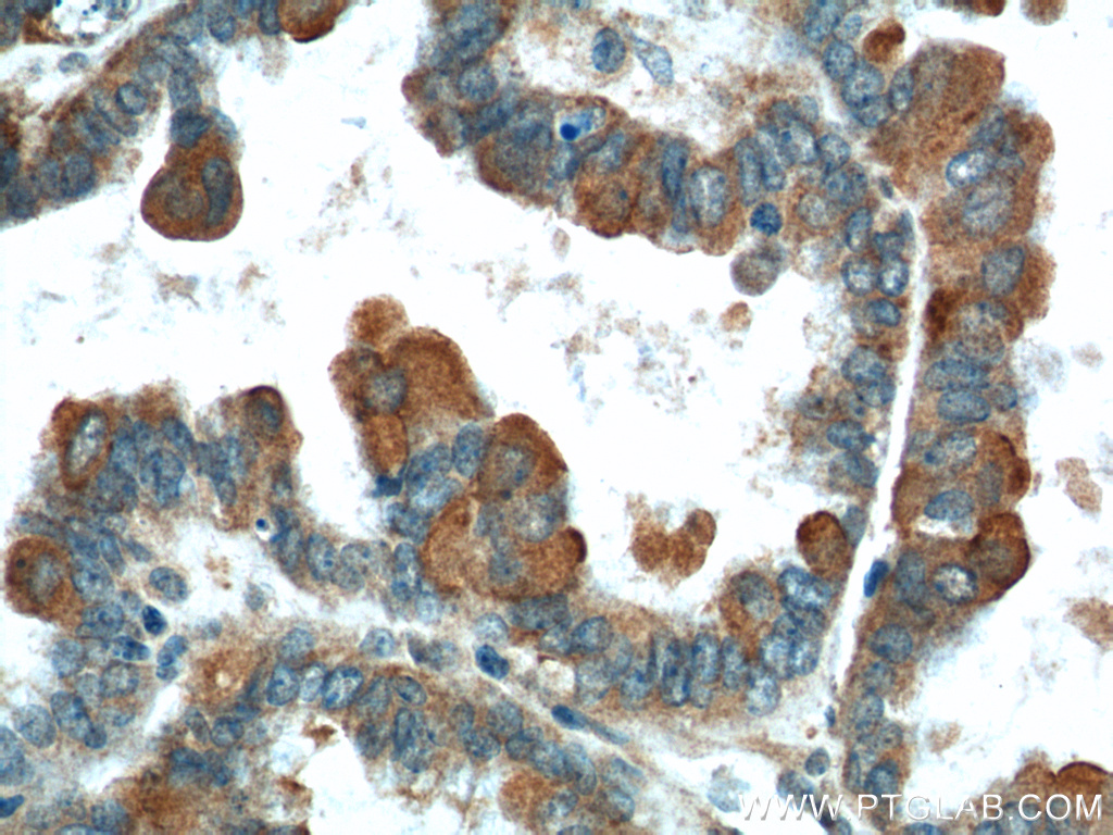 IHC staining of human ovary tumor using 12080-1-AP