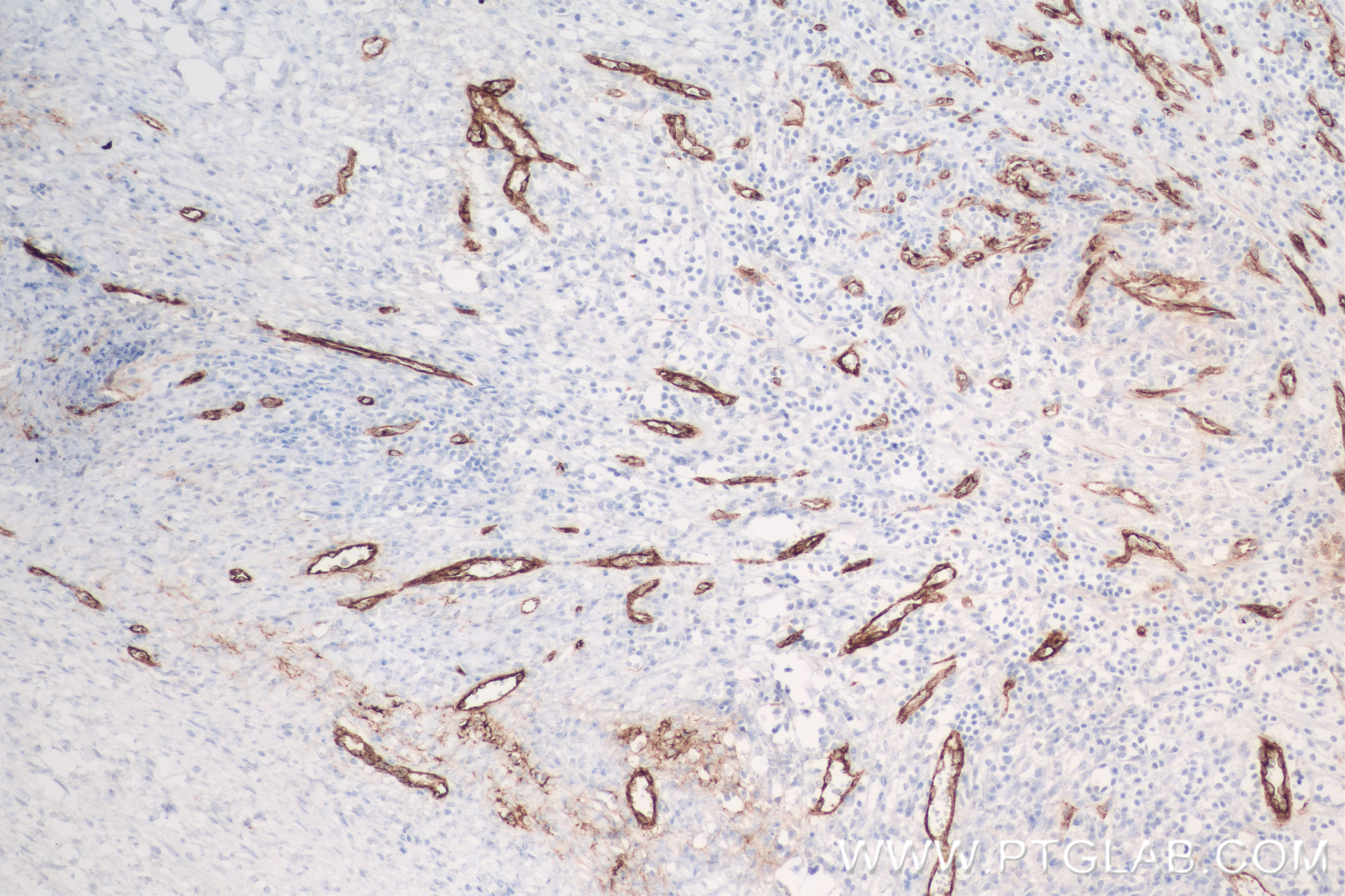 IHC staining of human ovary cancer using 83854-2-RR (same clone as 83854-2-PBS)