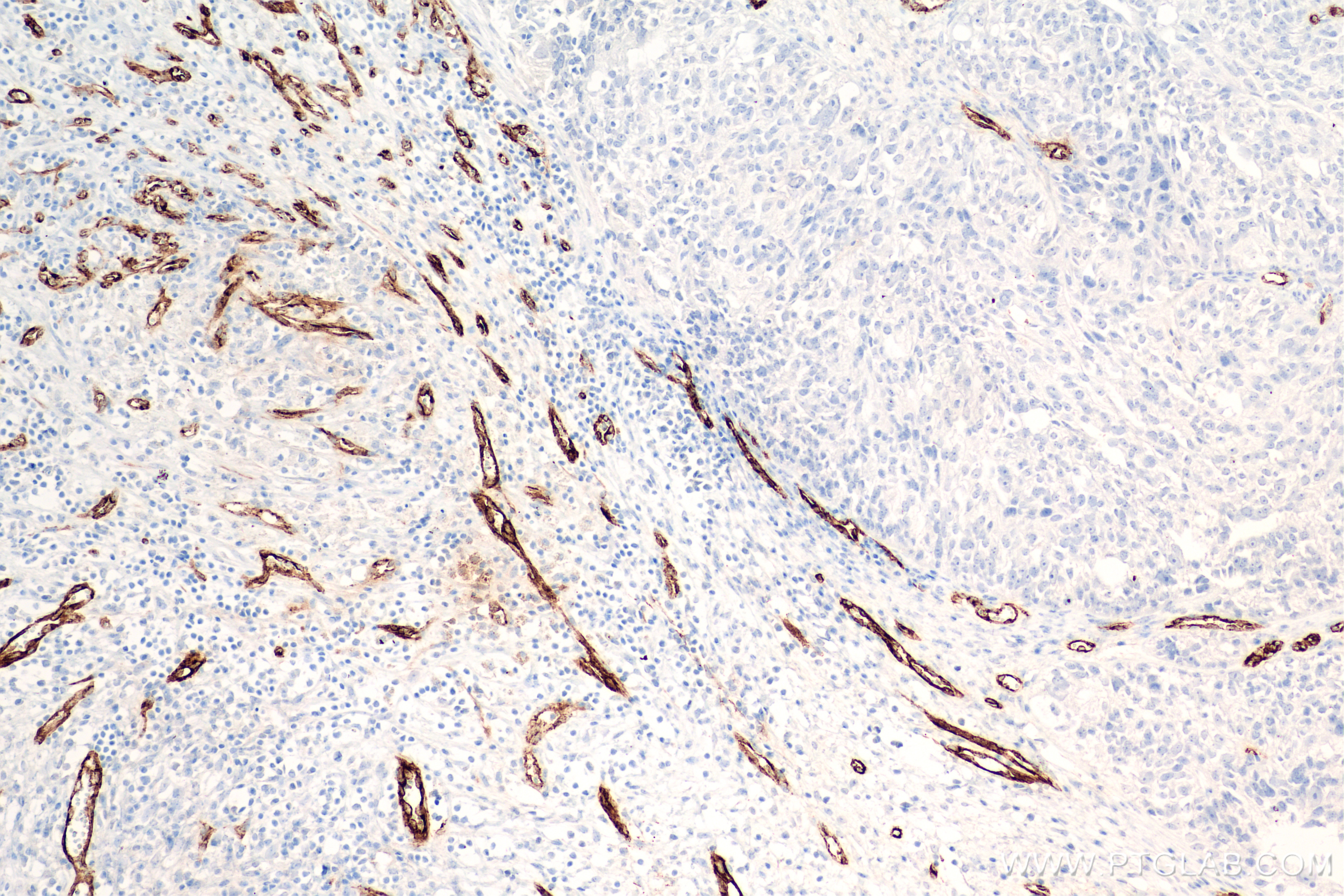 IHC staining of human ovary cancer using 83854-2-RR (same clone as 83854-2-PBS)