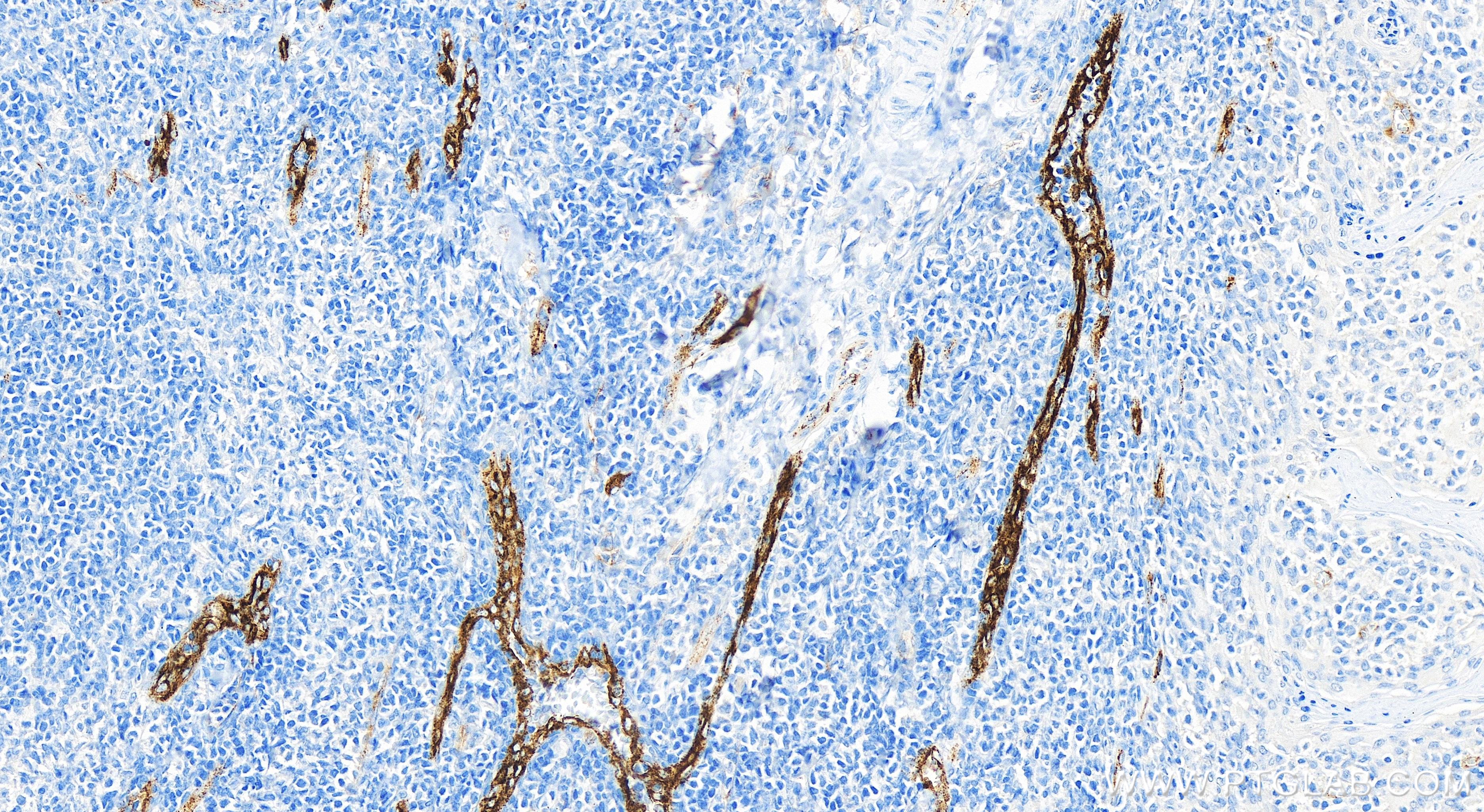 IHC staining of human tonsillitis using 83854-2-RR (same clone as 83854-2-PBS)