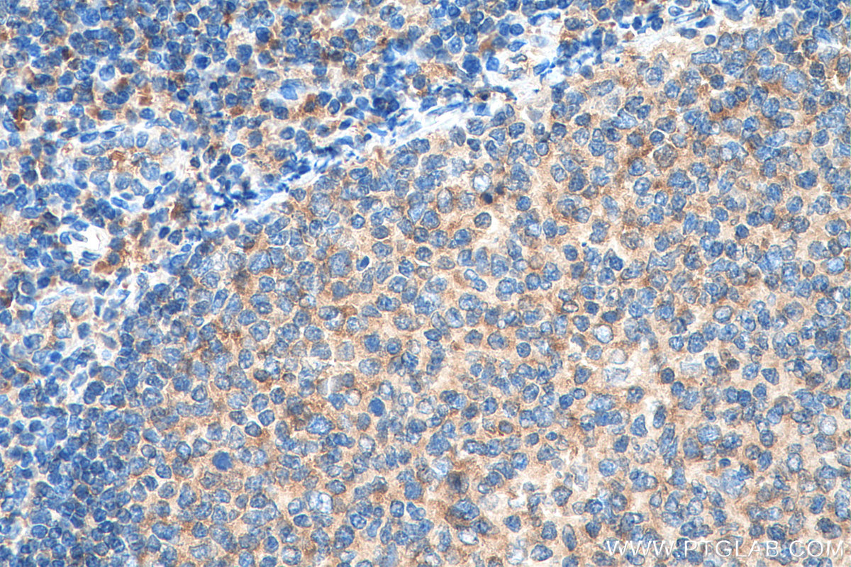 IHC staining of human tonsillitis using 67935-1-Ig (same clone as 67935-1-PBS)