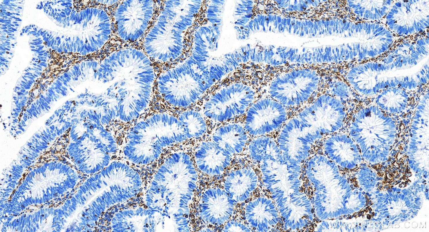 IHC staining of human colon cancer using 80232-1-RR