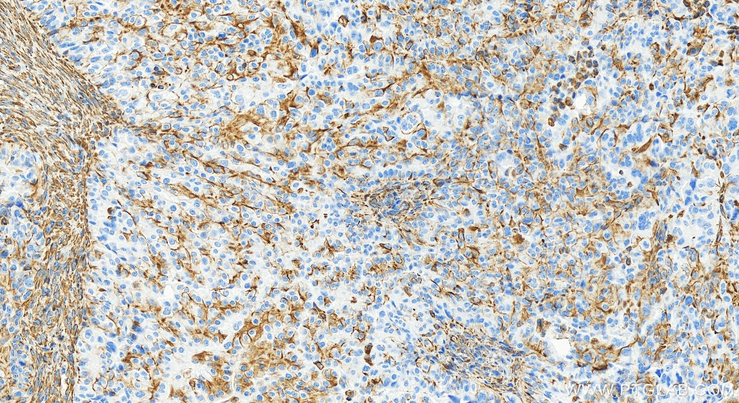 IHC staining of human ovary cancer using 80232-1-RR