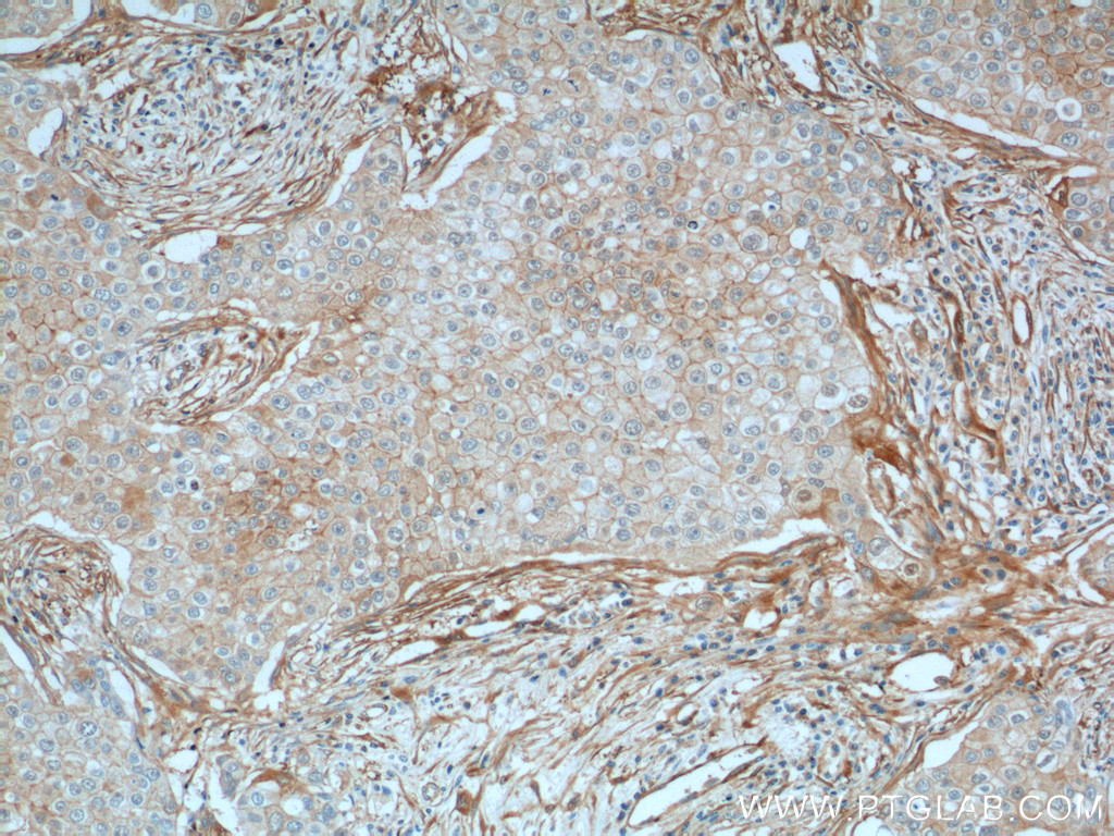 IHC staining of human breast cancer using 66305-1-Ig (same clone as 66305-1-PBS)