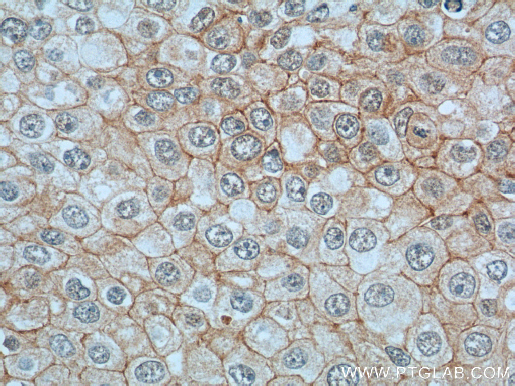 IHC staining of human breast cancer using 66305-1-Ig (same clone as 66305-1-PBS)