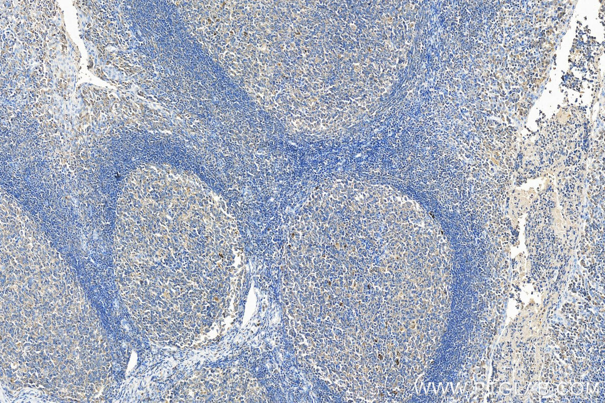 IHC staining of human tonsillitis using 10987-1-AP