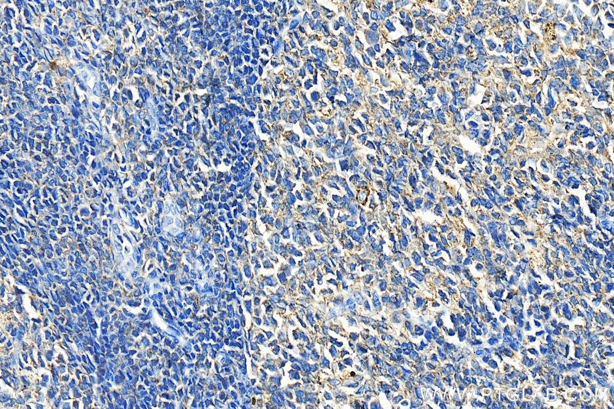 IHC staining of human tonsillitis using 10987-1-AP