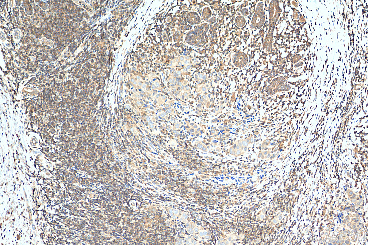 IHC staining of human breast cancer using 12030-1-AP