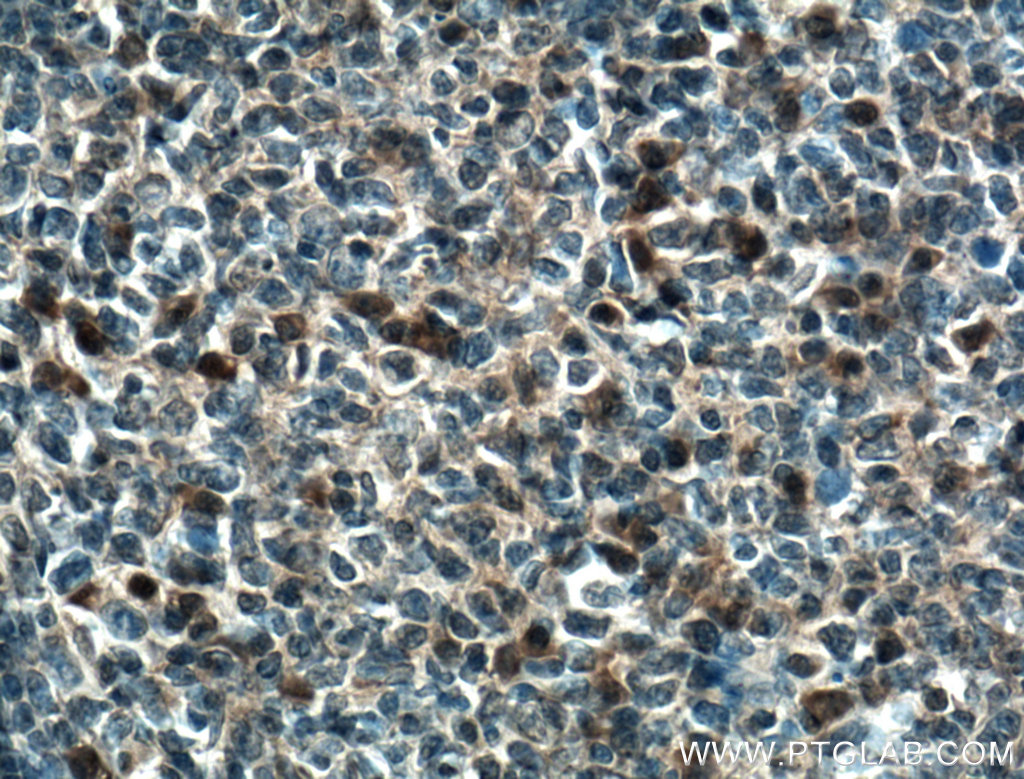 IHC staining of human tonsillitis using 17558-1-AP (same clone as 17558-1-PBS)