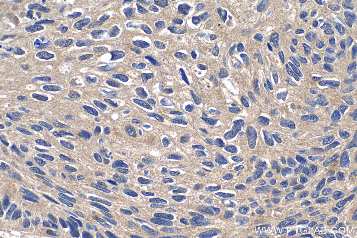 IHC staining of human lung cancer using 20478-1-AP