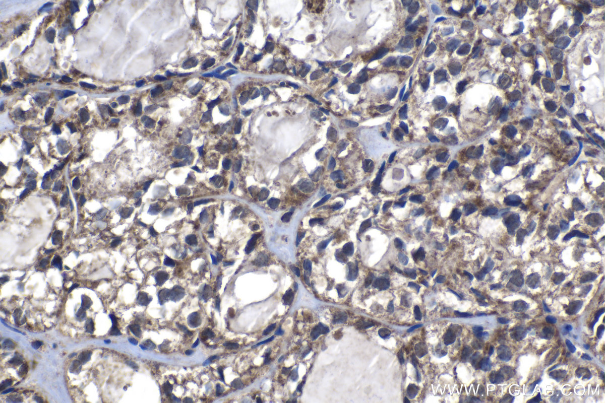 IHC staining of human thyroid cancer using 20478-1-AP