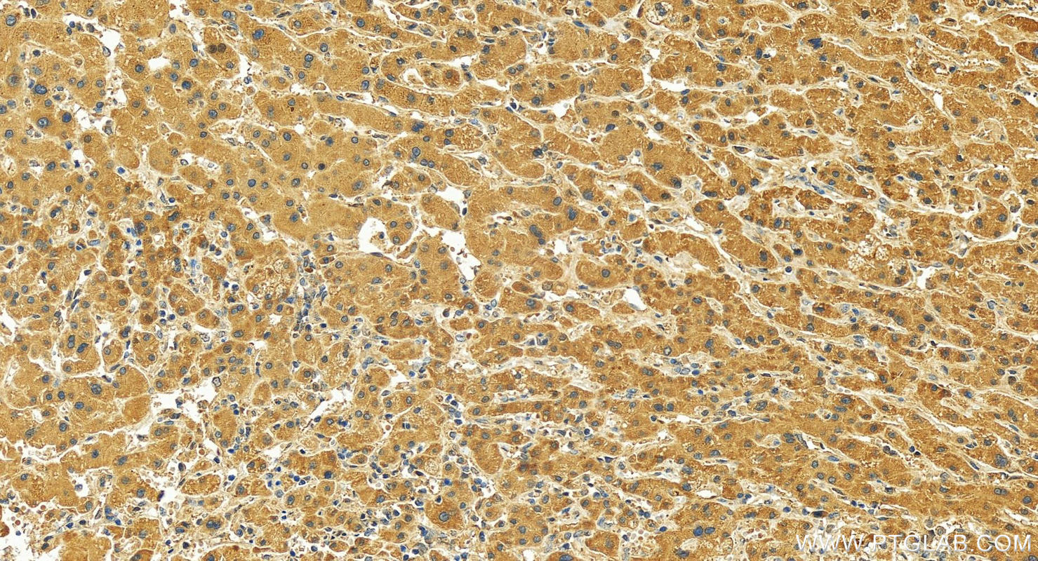 IHC staining of human intrahepatic cholangiocarcinoma using 16503-1-AP