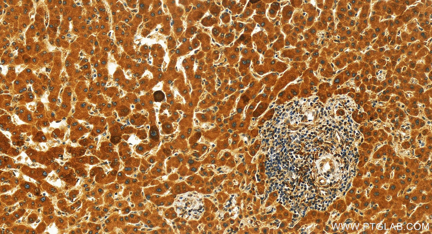 IHC staining of human intrahepatic cholangiocarcinoma using 20508-1-AP