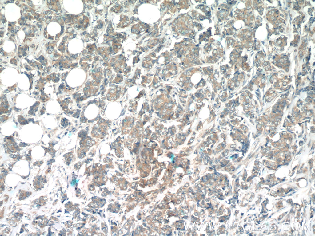 IHC staining of human breast cancer using 13204-1-AP