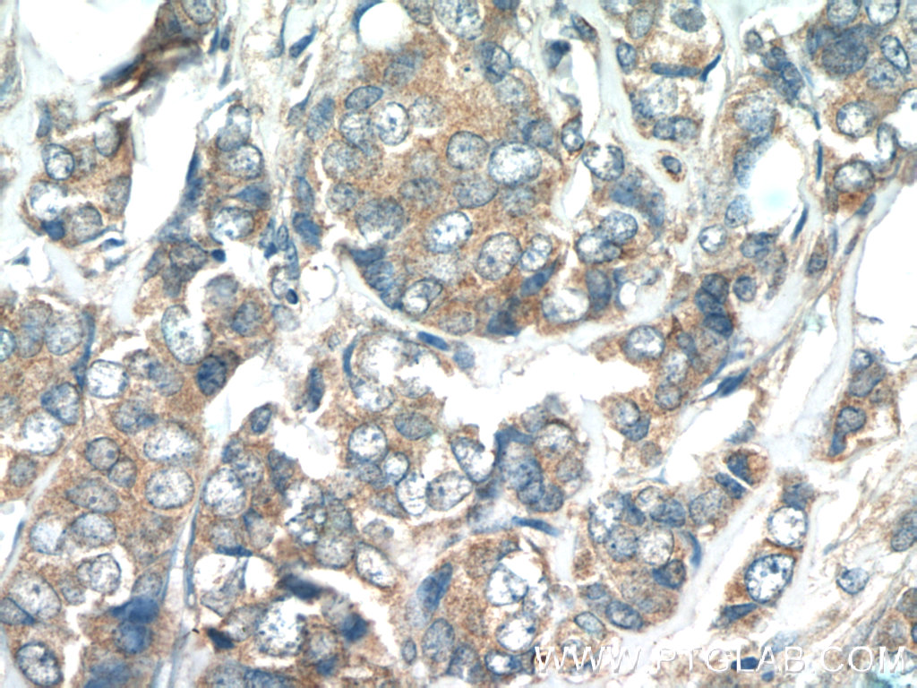 IHC staining of human breast cancer using 13204-1-AP