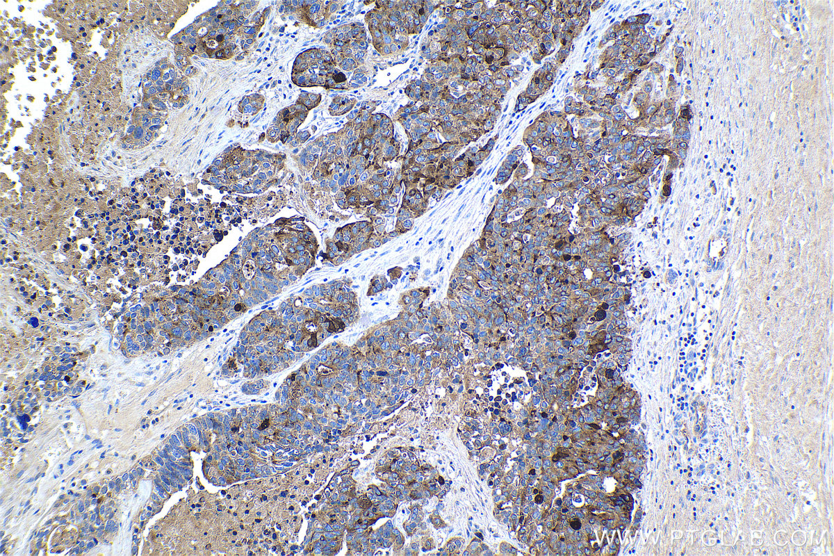 IHC staining of human ovary tumor using 14406-1-AP