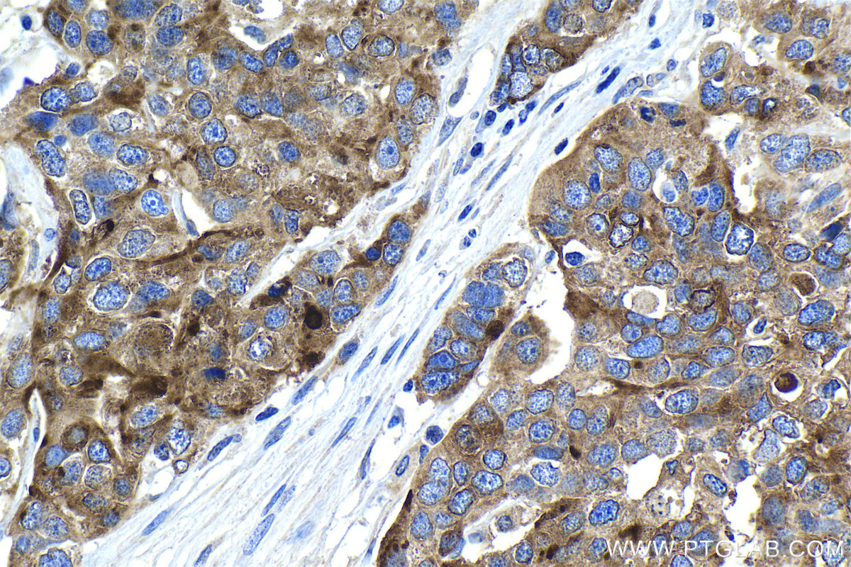 IHC staining of human ovary tumor using 14406-1-AP