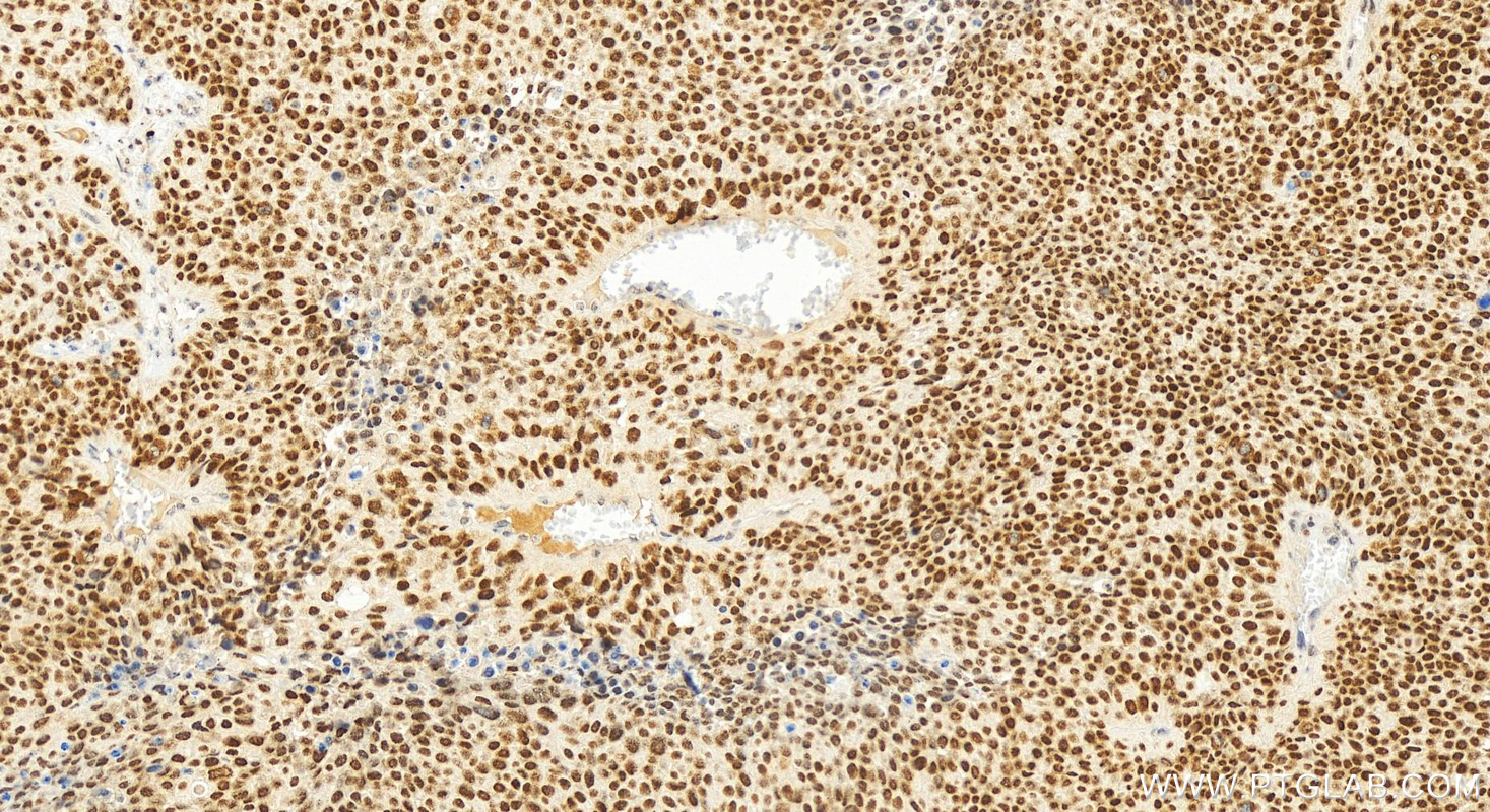 IHC staining of human lung squamous cell carcinoma using 11345-1-AP