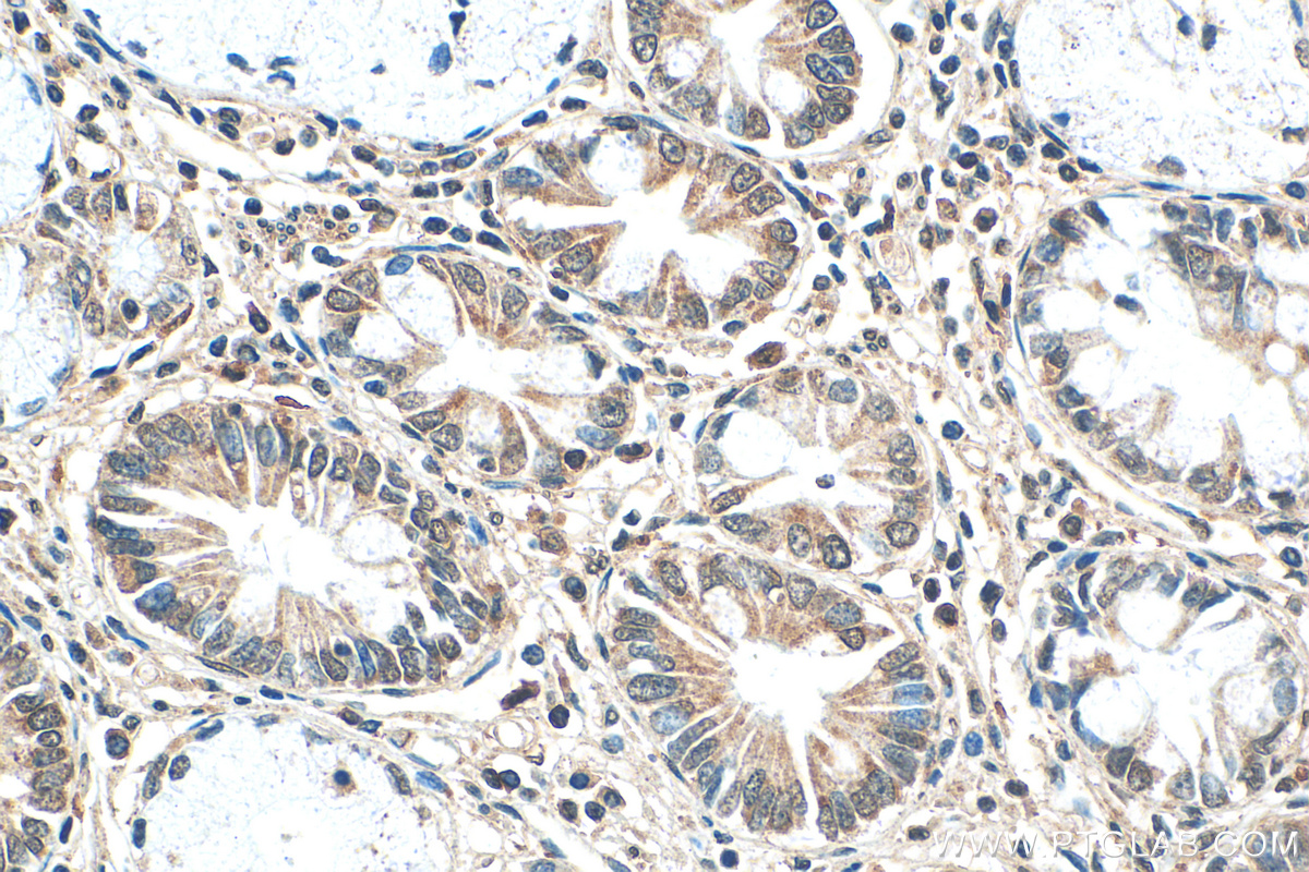 IHC staining of human stomach cancer using 22047-1-AP