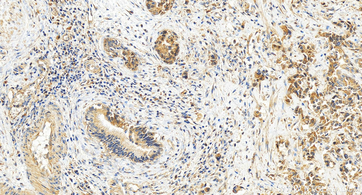 IHC staining of human intrahepatic cholangiocarcinoma using 25204-1-AP