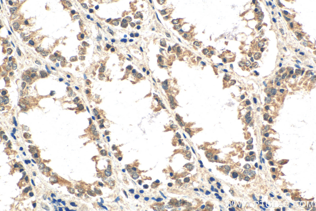 IHC staining of human colon cancer using 21259-1-AP