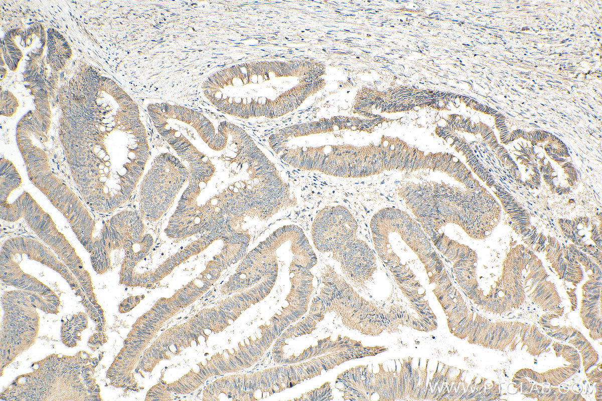 IHC staining of human colon cancer using 21259-1-AP