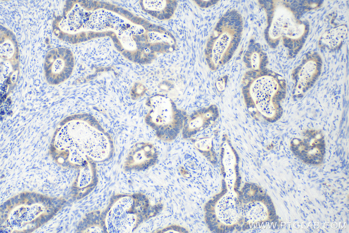 IHC staining of human colon cancer using 26406-1-AP