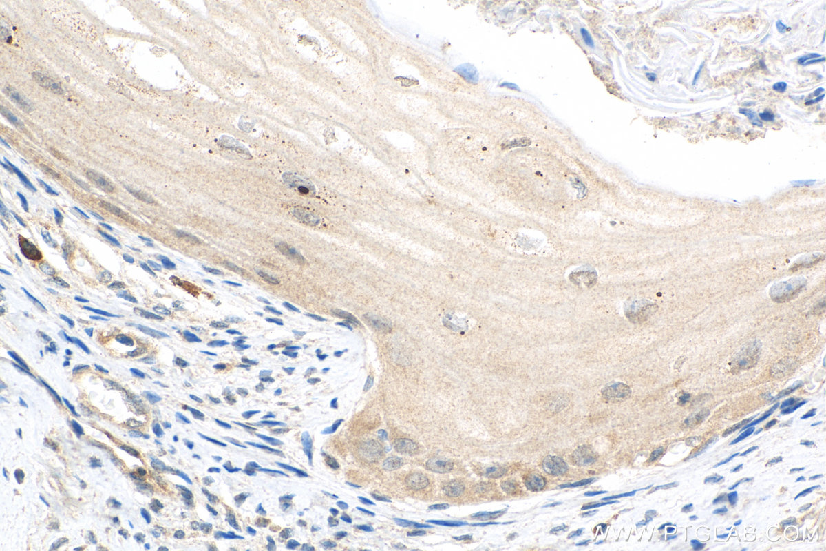 IHC staining of human ovary tumor using 15458-1-AP