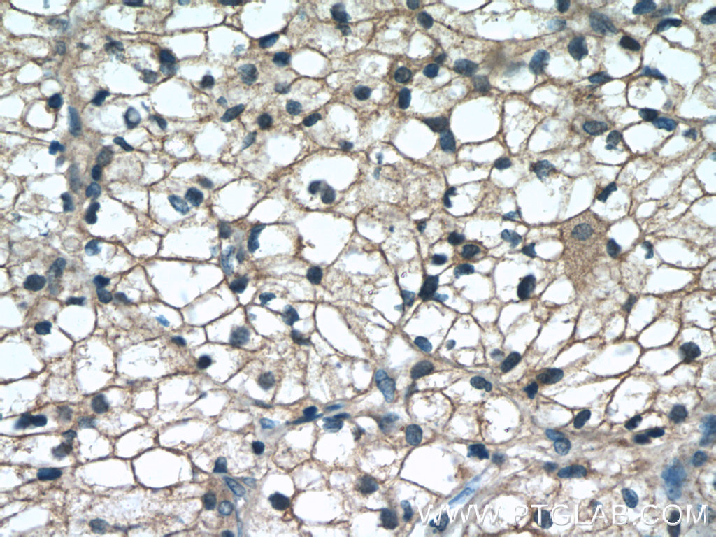 IHC staining of human nephroblastoma using 15458-1-AP