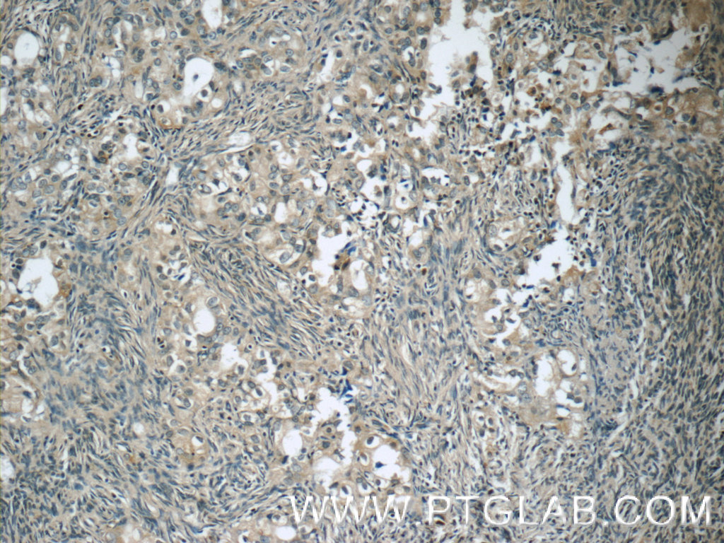 IHC staining of human ovary tumor using 15458-1-AP