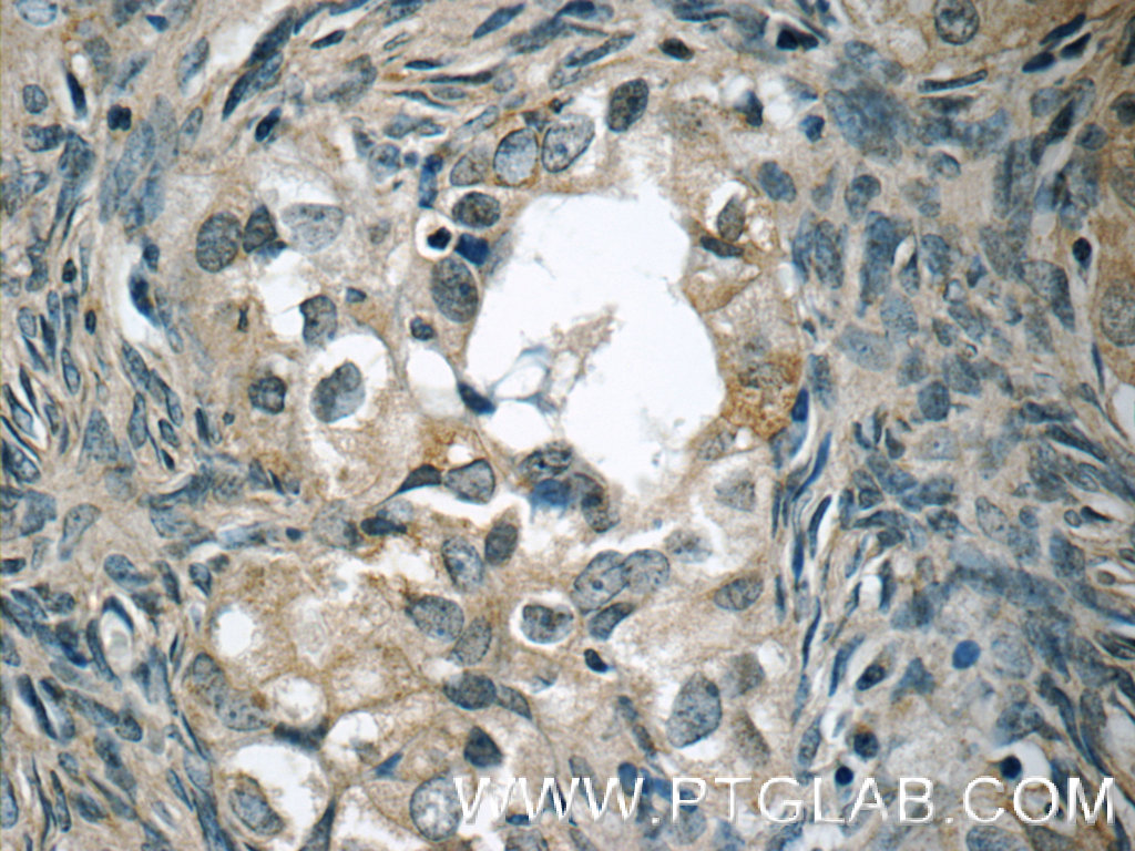 IHC staining of human ovary tumor using 15458-1-AP