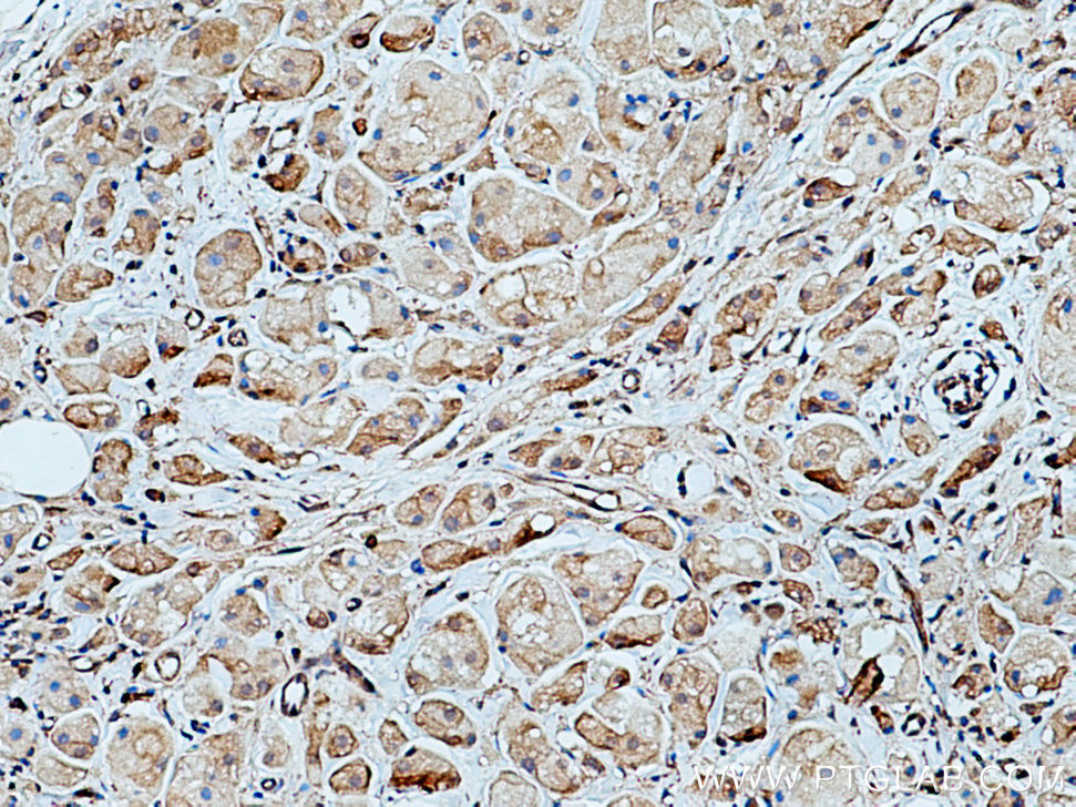 IHC staining of human breast cancer using 28357-1-AP